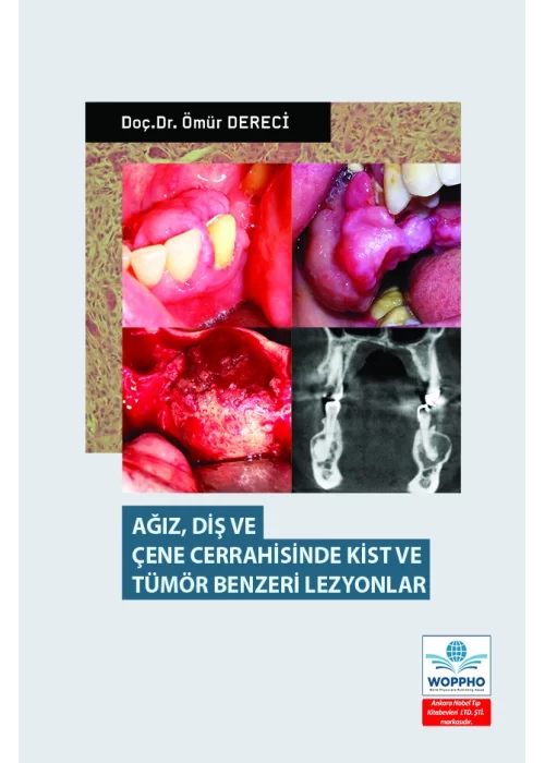 Ağız Diş ve Çene Cerrahisinde Kist ve Tümör Benzeri Lezyonlar
