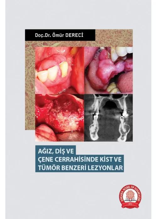 Ağız Diş ve Çene Cerrahisinde Kist ve Tümör Benzeri Lezyonlar