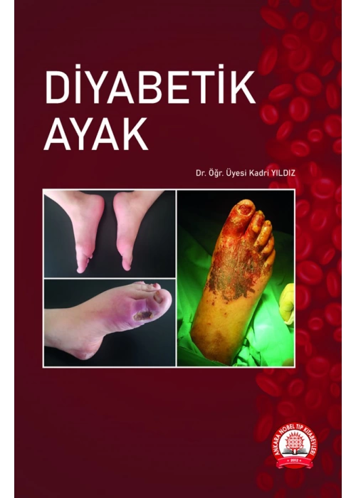 Diyabetik Ayak