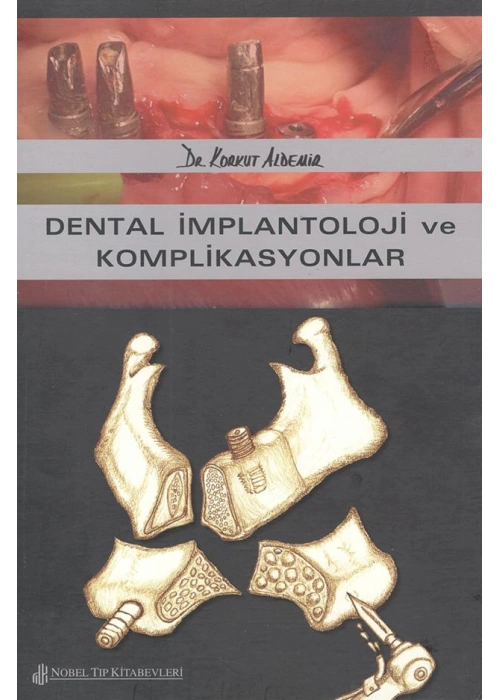Dental İmplantoloji ve Komplikasyonlar