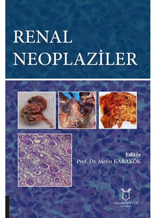 Renal Neoplaziler