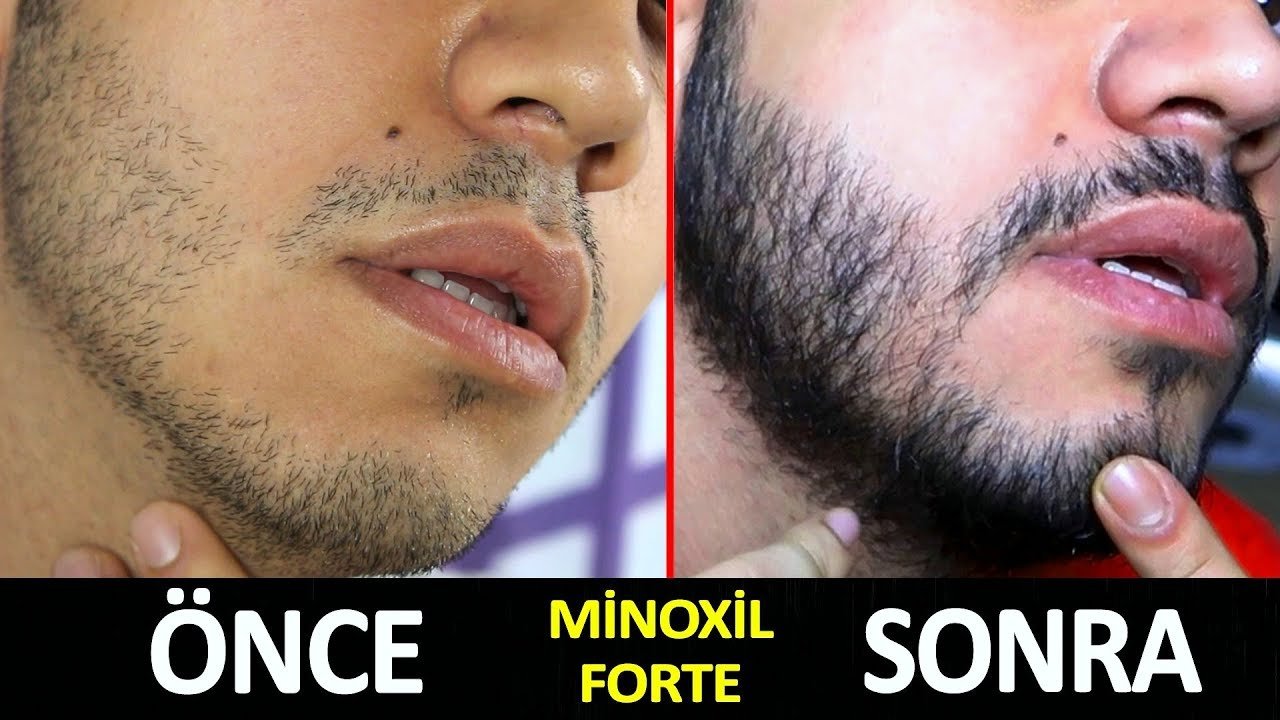 Minoxil Sakal Serumu