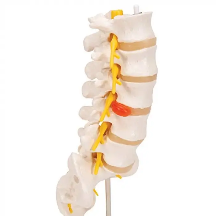 A76/5 Bel Omurga Sütunu, Dorso-Lateral Prolapsed Intervertebral Disk, 34 cm Yükseklik