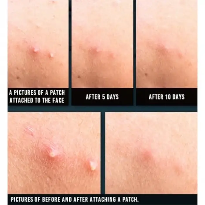 Acne Spot Patch Super Thin - Süper İnce Sivilce Bandı