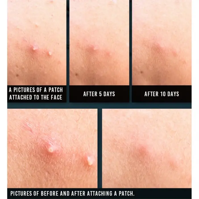 Acne Spot Patch Super Thin - Süper İnce Sivilce Bandı