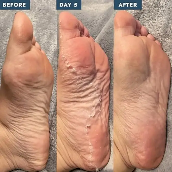 Peeling Bakım Çorabı 40 Ml