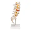 A76/5 Bel Omurga Sütunu, Dorso-Lateral Prolapsed Intervertebral Disk, 34 cm Yükseklik