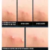 Acne Spot Patch Super Thin - Süper İnce Sivilce Bandı