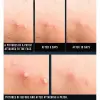Acne Spot Patch Super Thin - Süper İnce Sivilce Bandı