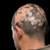 Alopesi Areata(Saçkıran) Destek Seti