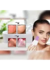 Mey İthalat® ULTRASONIC SİYAH NOKTA  AKNE SPATULA ŞARJLI CİLT TEMİZLEYİCİ