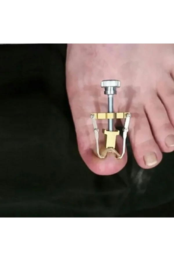 Batık Tırnak Düzeltme Aleti