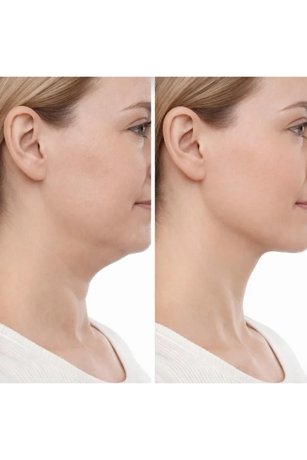 Lenfatik Drenaj Masaj Fırçası