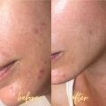 92 Purlés Sebo Regulating Elixir Sivilce Problemleri İçin Sebum Dengeleyici Serum 50 ml