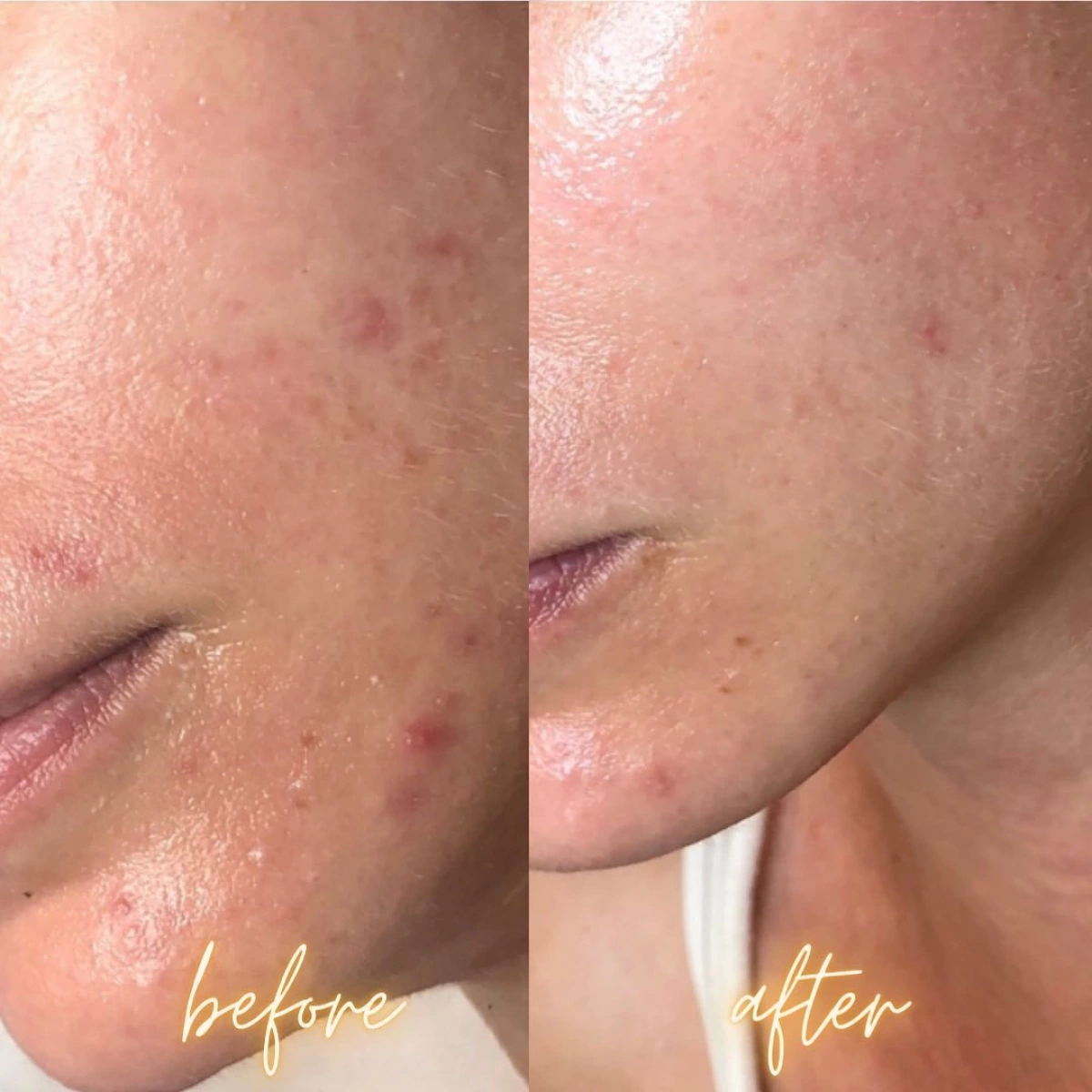 92 Purlés Sebo Regulating Elixir Sivilce Problemleri İçin Sebum Dengeleyici Serum 50 ml