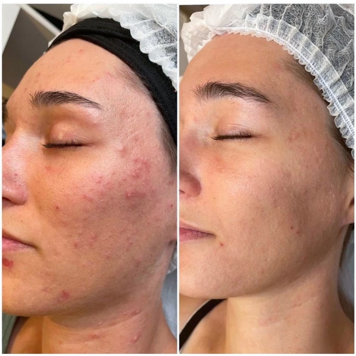 Purlés Baby Face Set