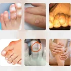 Ayak Serçe Parmak Nasır Koruyucu Silikon 2 Adet