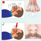 Horlama Önleyici Burun Aparatı