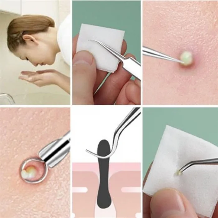 11 Parça Siyah Nokta Temizleyici Cilt Bakım Komedon Seti (5047)