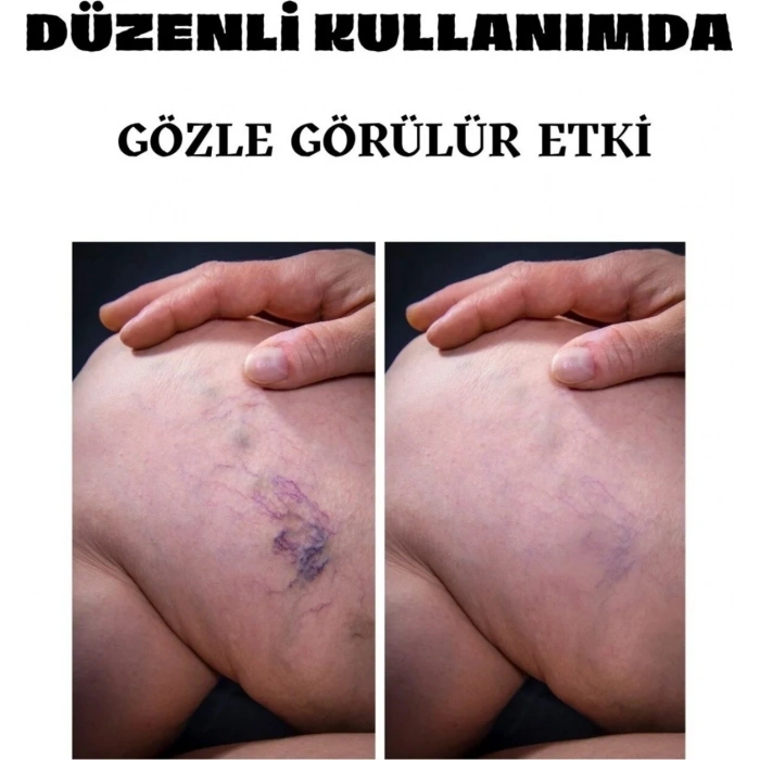 Hubrendy Bez Varicose Kremi 100 ml