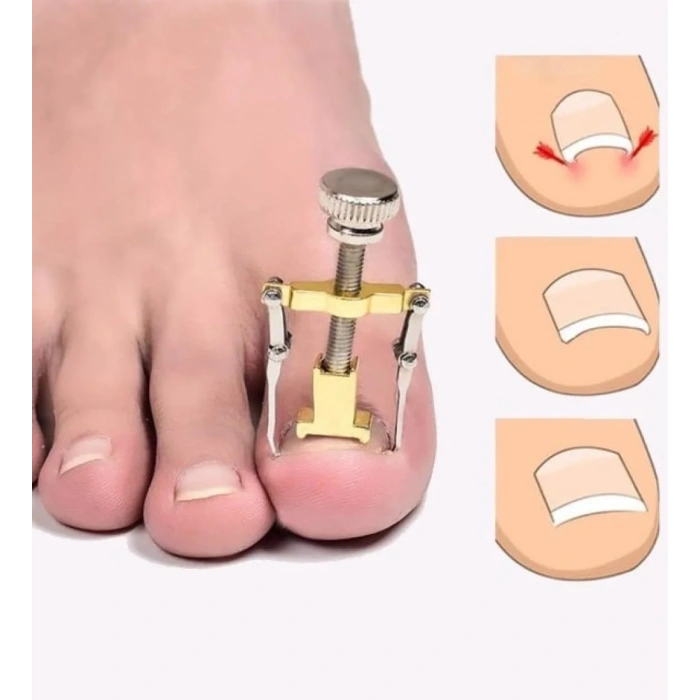 USLUCAN ALIŞVERİŞ Batık Tırnak Çıkarma Aparatı