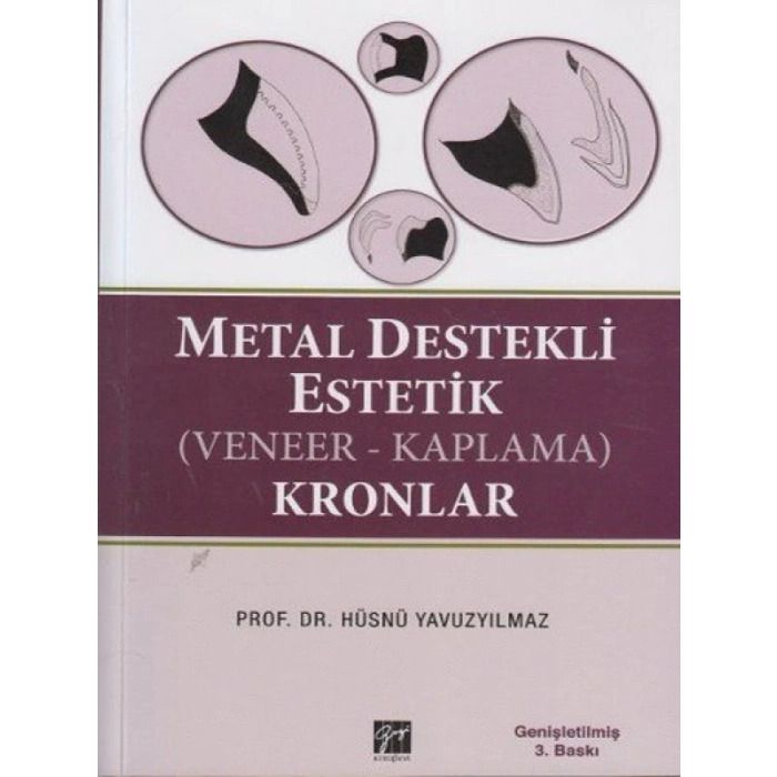 Metal Destekli Estetik (Veneer-Kaplama) Kronlar - Prof. Dr. Hüsnü Yavuzyılmaz