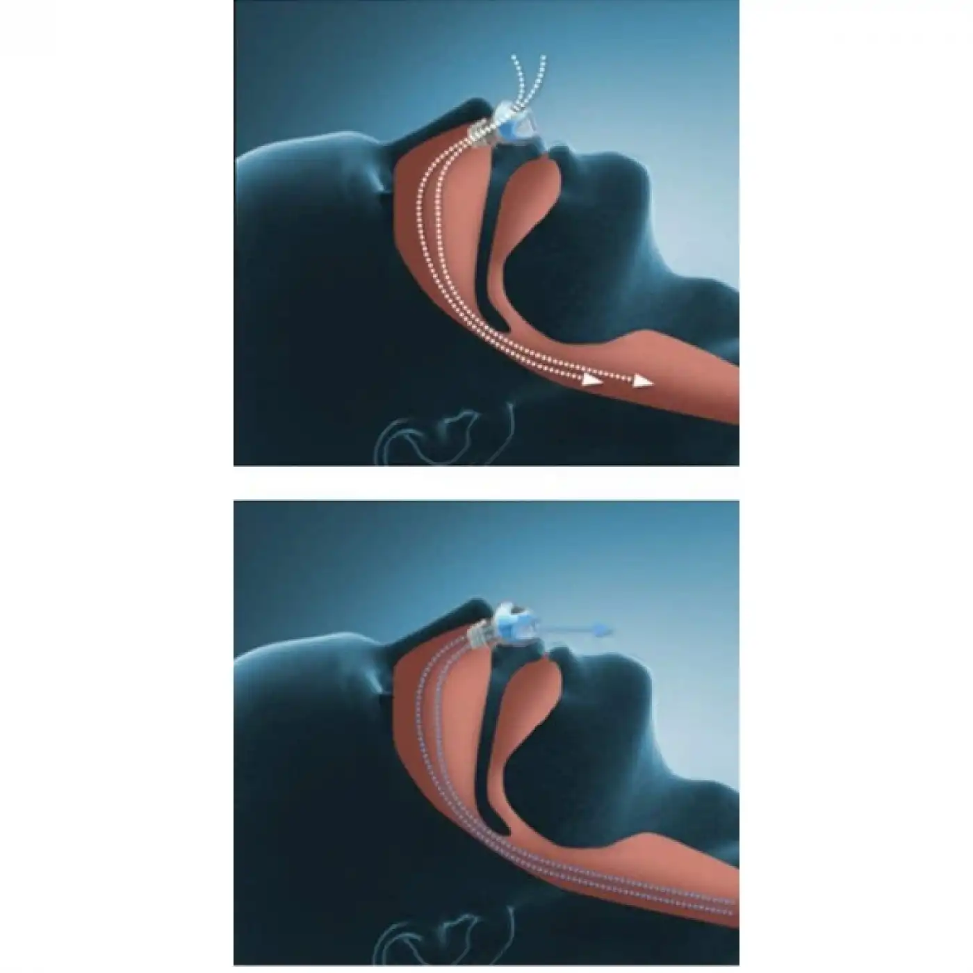 Horlama Önleyici Rahat Uyku Atı