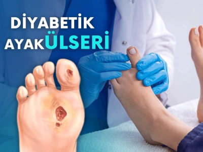 Diyabetik Ayak Ülseri