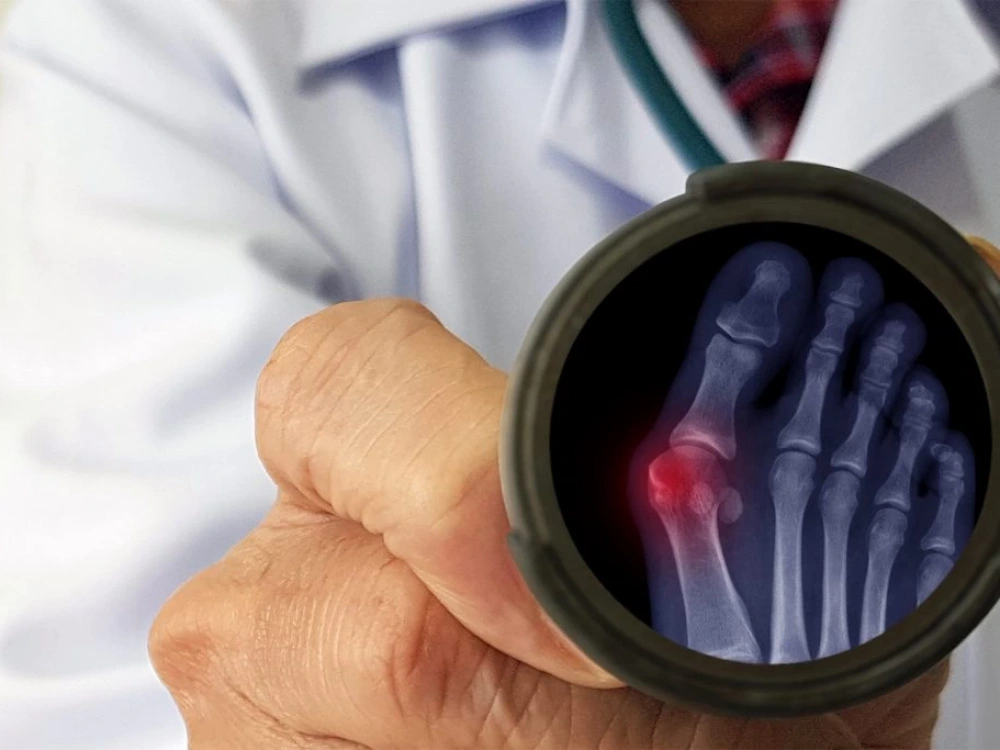 Ayak Başparmağı Kemik Çıkıntısı (Bunyon/Halluks Valgus) Hakkında Merak Edilenler