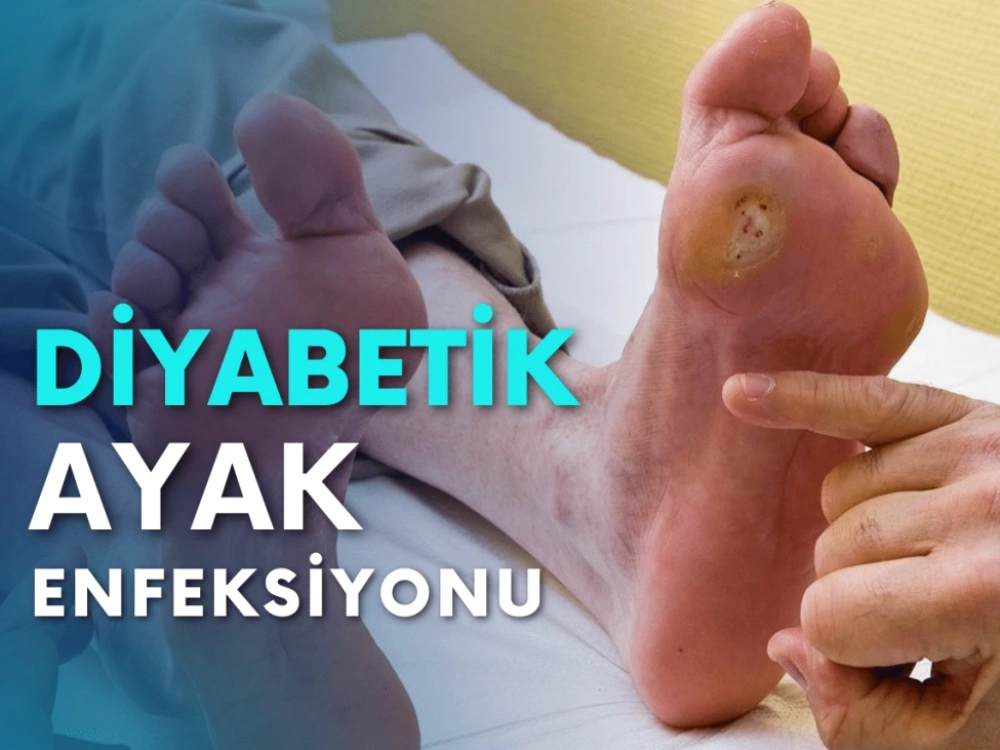 Diyabetik Ayak Enfeksiyonları ve Tedavisi