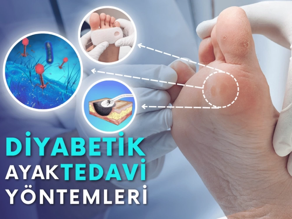 Diyabetik Ayak Tedavi Yöntemleri