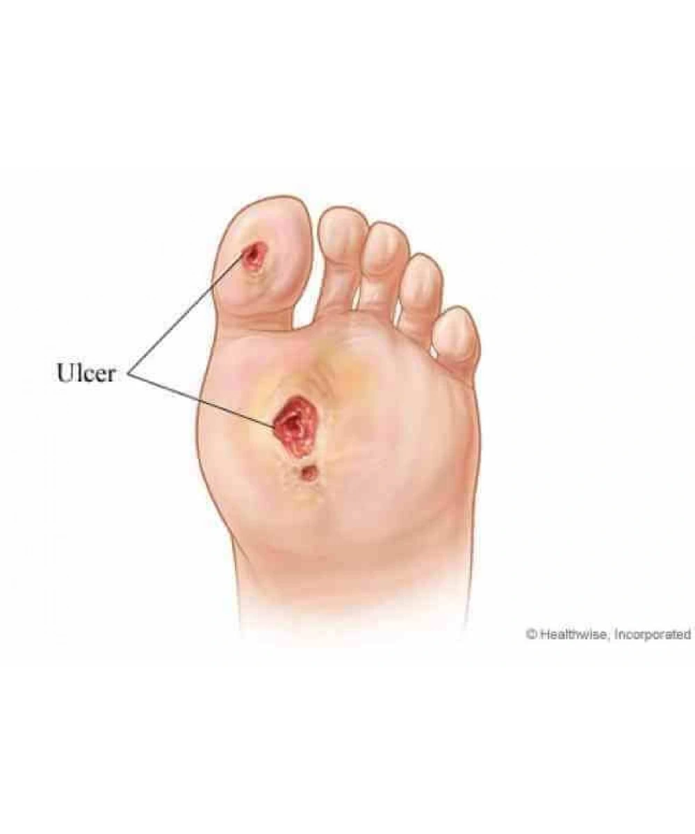 Diabetik Ayak Kişiye Özel Tabanlık (Özel Cihaz ile Analiz Yapılarak Hazırlanmaktadır)