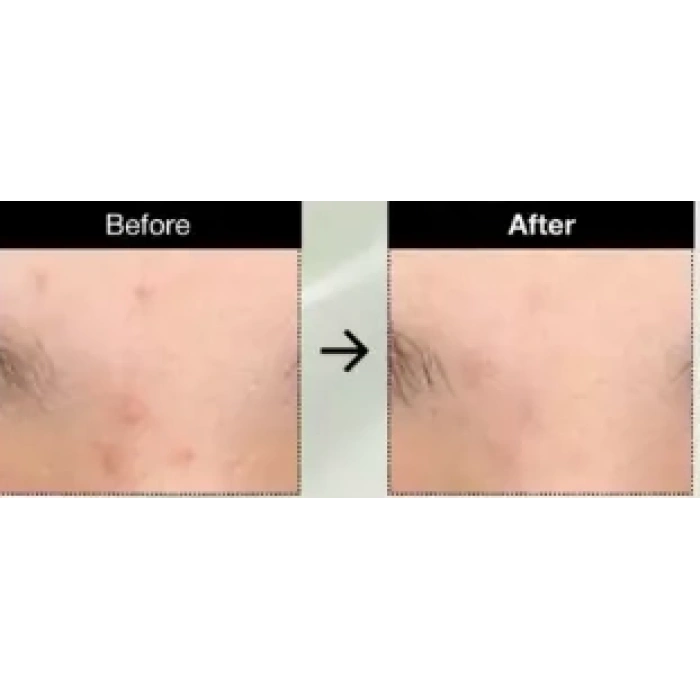 Anua - Heartleaf Centella Red Spot Cream(leke kremi)