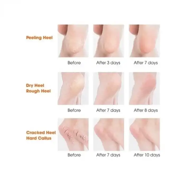 AsilTech Silikon Topuk Nemlendirici Çorap