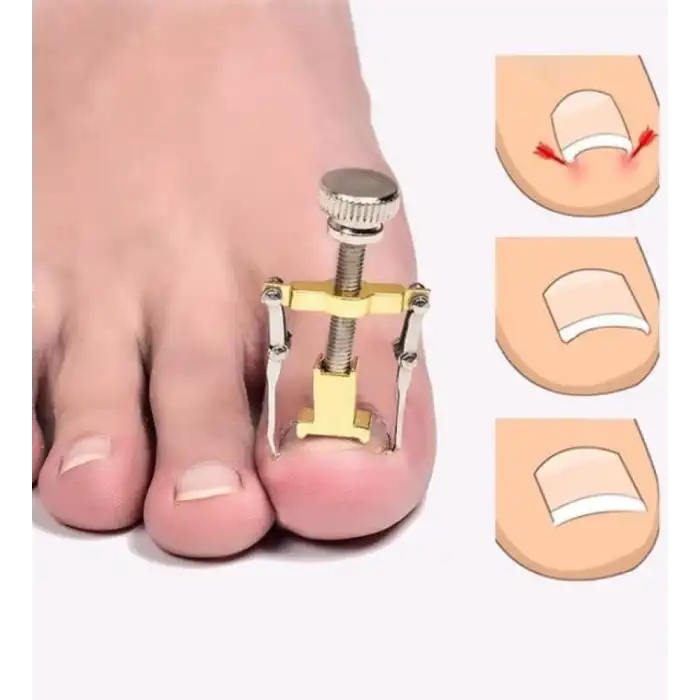 Batık Tırnak Çıkarma Aparatı