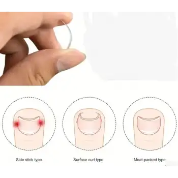 Baş Parmak Tırnak Batmasını Engelleyen Metal Aparat Nrd 603 *