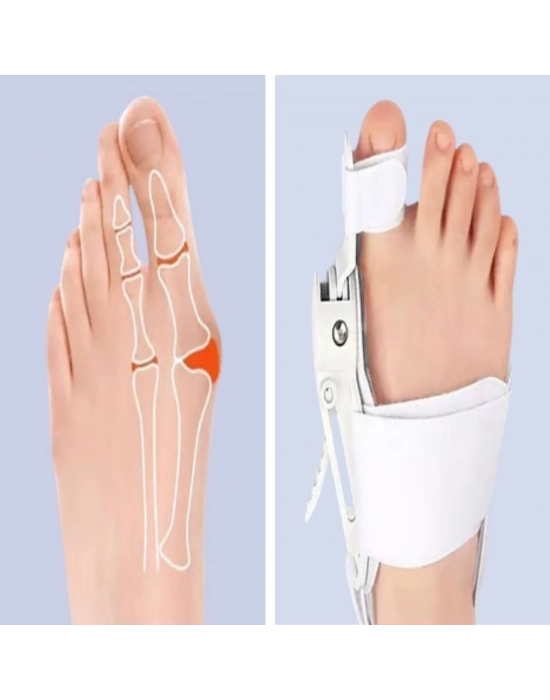 ®  Ayarlanabilir Ayak Baş Parmak Kemik Düzeltici – Halluks Valgus (Bunyon) Aparatı, Gece Gündüz Kullanıma Uygun Ayak Düzeltme Ateli