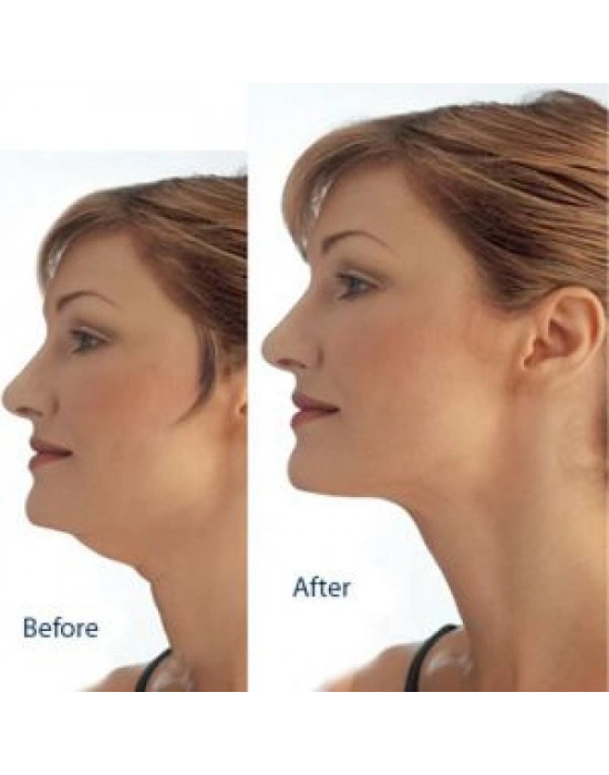 Gıdı Toparlama Boyun Gıdı Masaj Aleti