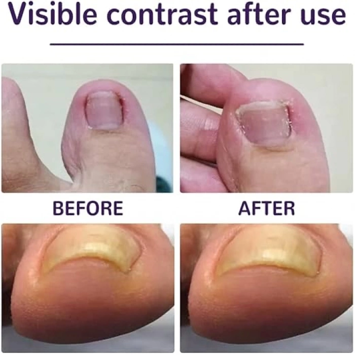 ÇOK SATAN Ayak Tırnağı Düzeltme Bandı 50 Adet