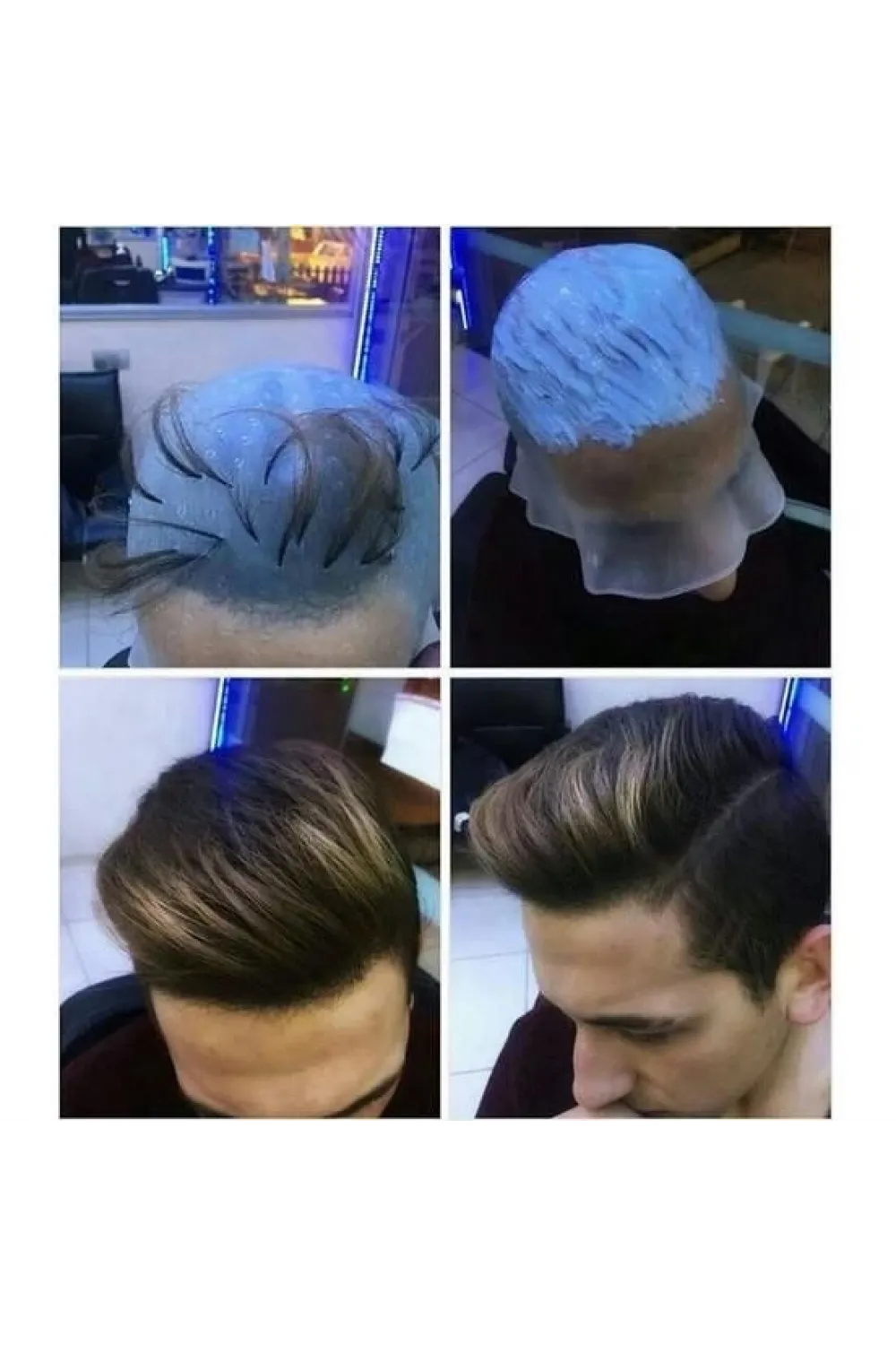 Profesyonel Silikon Delikli Röfle Bonesi
