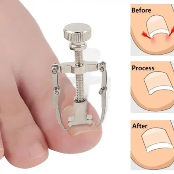 Batık Tırnak Çıkarma Aparatı