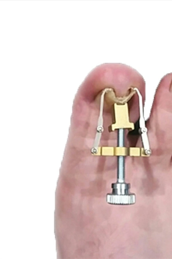 Batık Tırnak Düzeltme Aleti