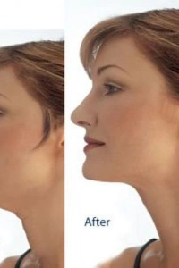 Gıdı Toparlama Boyun Gıdı Masaj Aleti