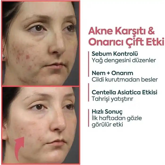 CLASYCARE Akne Kremi Yüz İçin – Sivilce ve Akne Karşıtı Leke Kremi – Salisilik Asit & Niasinamid ile Leke Giderici – Genç ve Yetişkin Cilt Bakımı, 40 ml