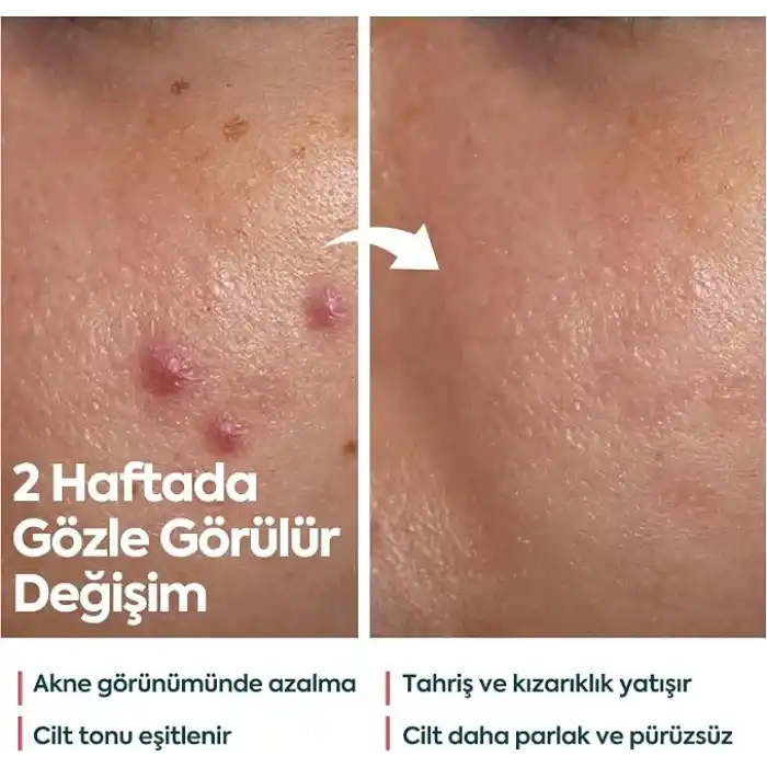 CLASYCARE Akne Kremi Yüz İçin – Sivilce ve Akne Karşıtı Leke Kremi – Salisilik Asit & Niasinamid ile Leke Giderici – Genç ve Yetişkin Cilt Bakımı, 40 ml