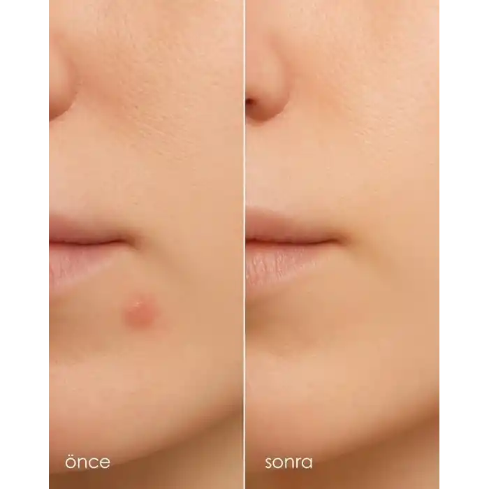 StopEver Clearly Spot Patch, Sivilce Karşıtı Şeffaf Plaster 2li Paket | Ultra İnce, Hidrokolloid + Niacinamide + Salicylic Asit İçerikli Akne Karşıtı Yüz Bandı | 48 adet (2 x 24)