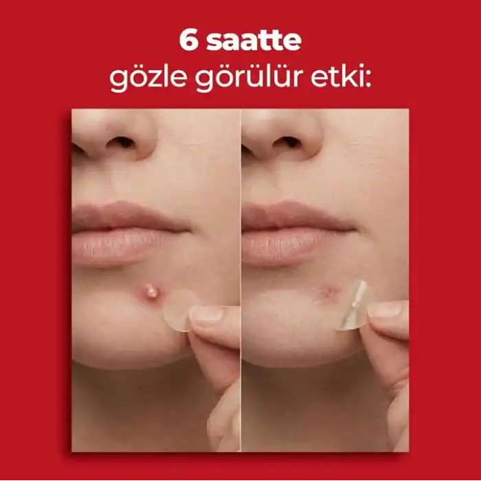 Sivilce Bandı, Aktif-Hızlı Sonuç, 144 Adet, Hidrokolloid Akne Bandı