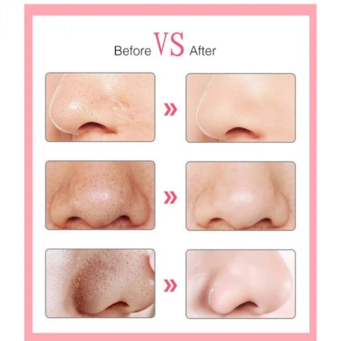 6 Başlıklı Vakumlu Siyah Nokta Temizleyici