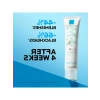 40ml Sivilce ve Siyah Nokta Kremi