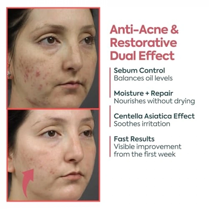 40 ml Sivilce ve Akne Karşıtı Leke Kremi